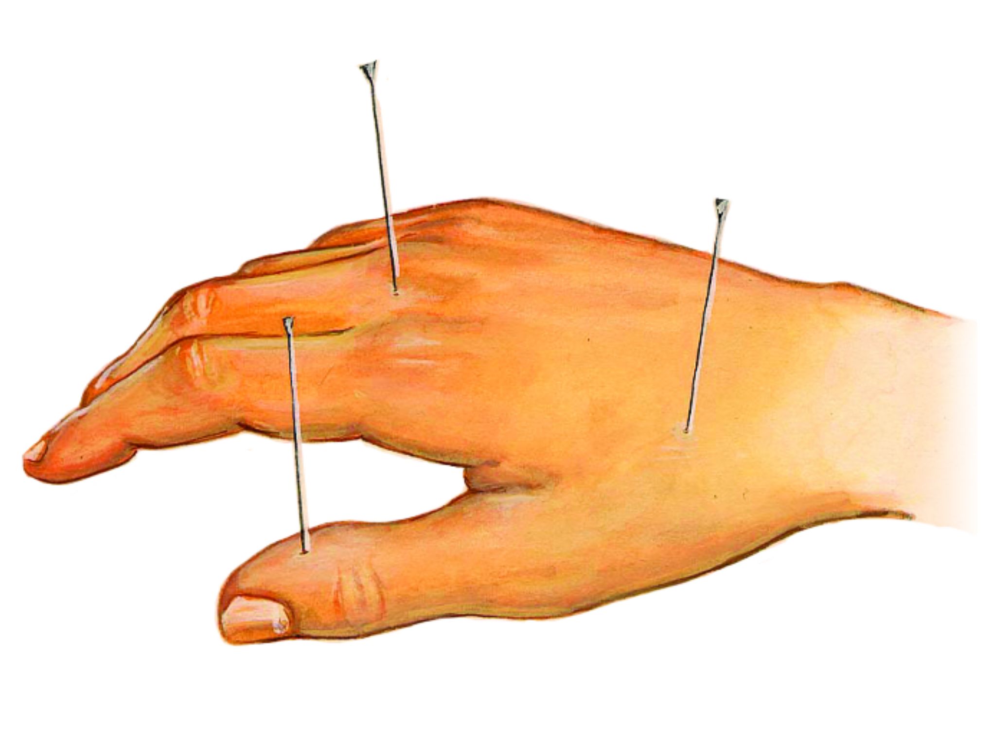 aiguilles d’acupuncture